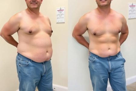 abdominoplasty abdominoplasty surgery romania